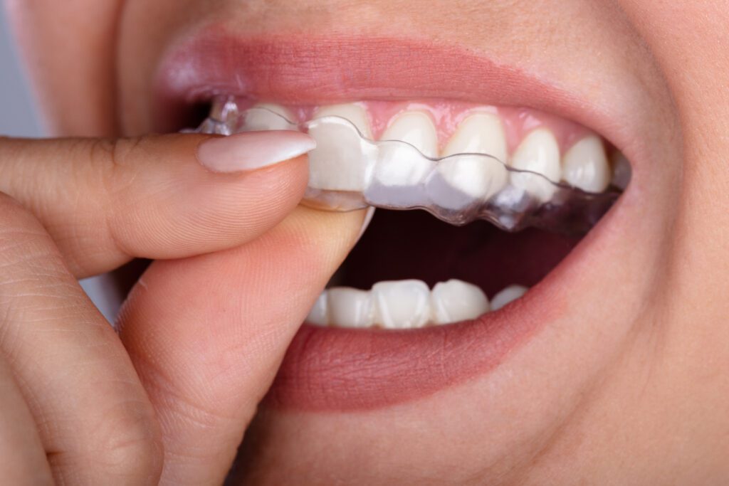 clear aligners Sacramento
