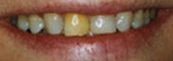 before14