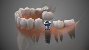 dental implants Sacramento