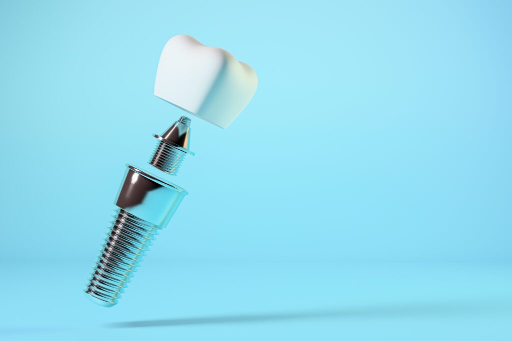 dental implants in Sacramento